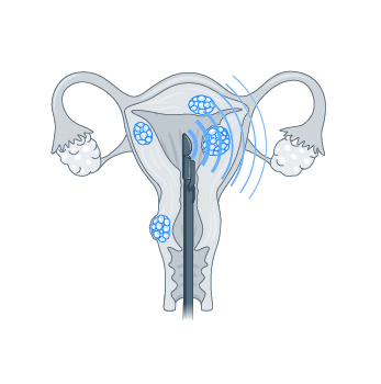 Grafische Darstellung der schallgestützten Behandlung eines Myoms in der Gebärmutter mittels der Sonata®-Methode