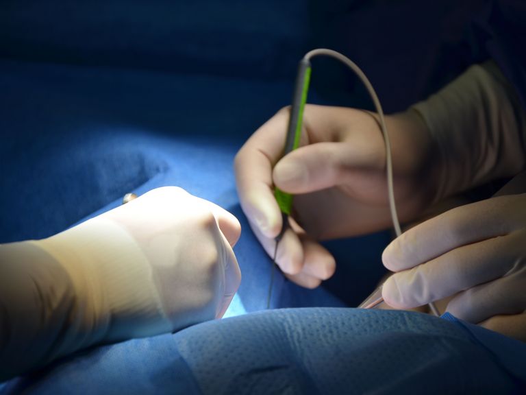Detailaufnahme einer Operation im Operationssaal, Zentrum Endokrine Chirurgie, Evangelisches Amalie Sieveking Krankenhaus, Hamburg-Volksdorf