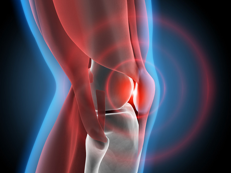 Grafik eines Knies, dass Arthrose darstellen soll - Evangelsiches Amalie Sieveking Krankenhaus Hamburg - Pseudoarthrose behandeln